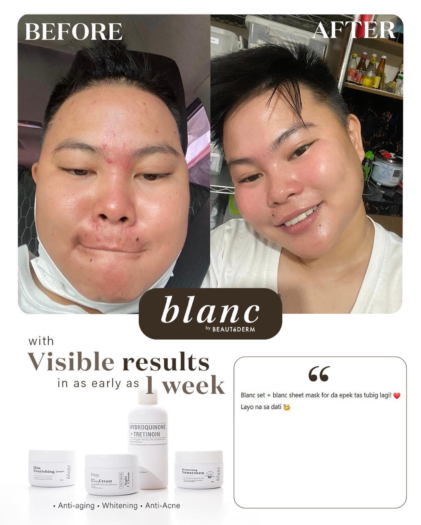 Blanc Set Regular Size (2 months use) with FREEBIES